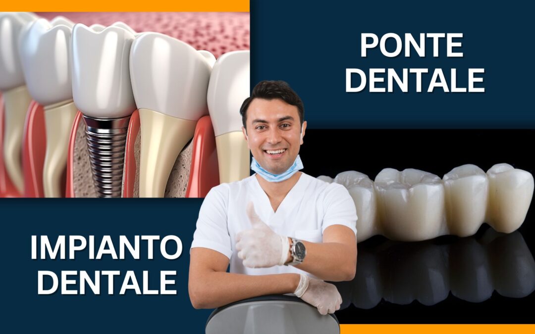 Impianto Dentale vs. Ponte Fisso: Qual è la Scelta Migliore per Sostituire i Denti Mancanti?